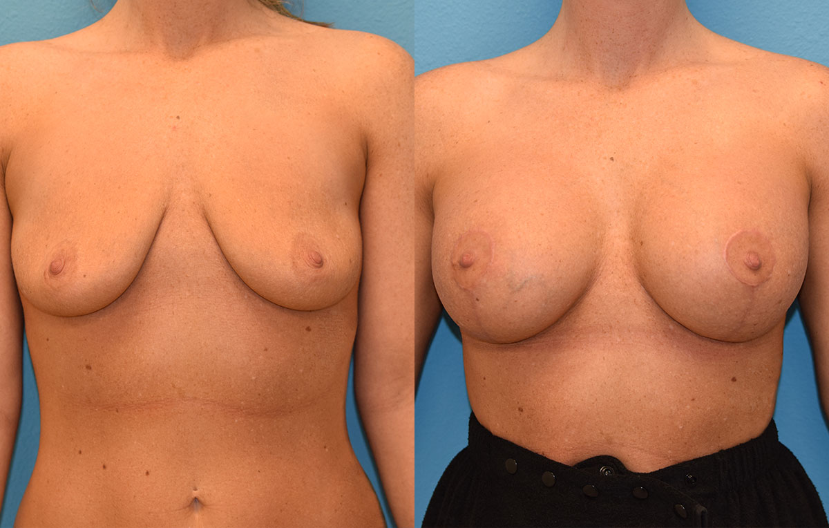 Breast augmentation with a lift results by Dr. Maningas at Maningas Cosmetic Surgery in Missouri and Arkansas