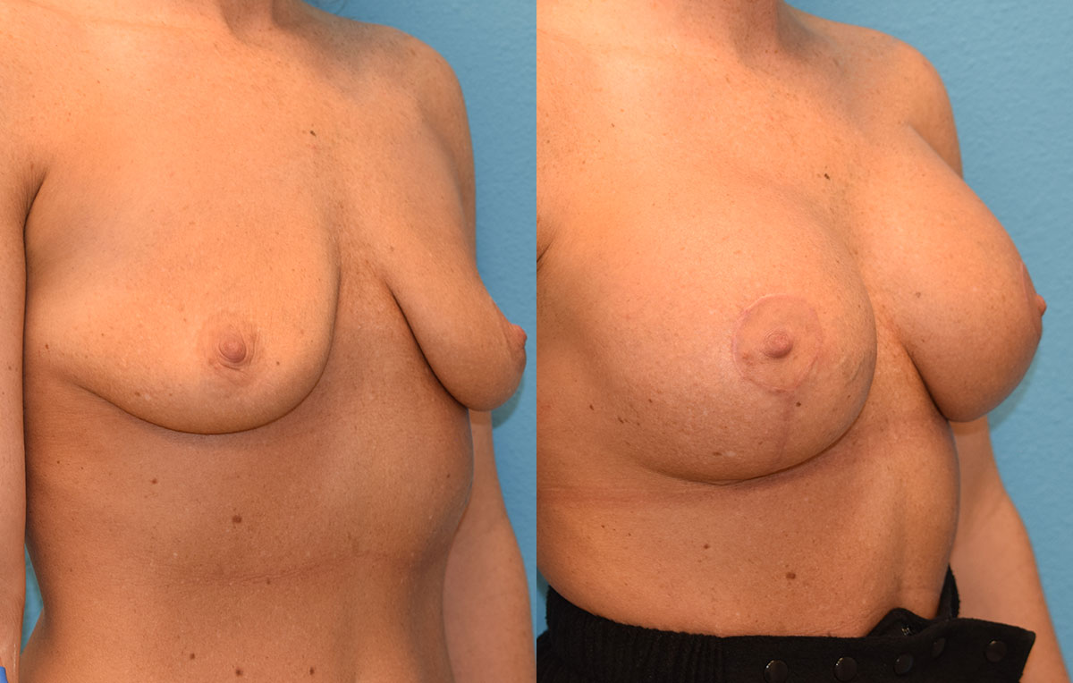 Breast augmentation with a lift results by Dr. Maningas at Maningas Cosmetic Surgery in Missouri and Arkansas