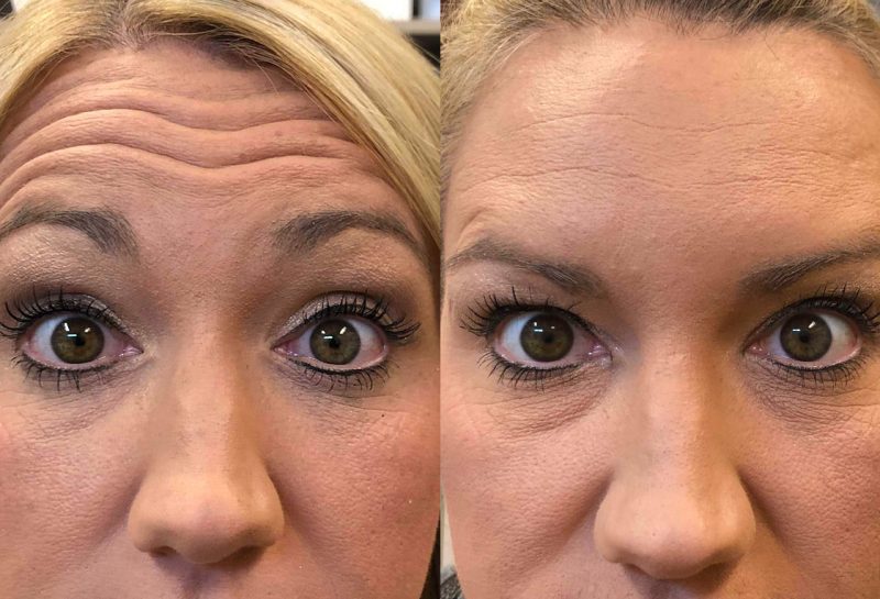 Botox Results in Joplin at Maningas Cosmetic Surgery by Nurse Beth
