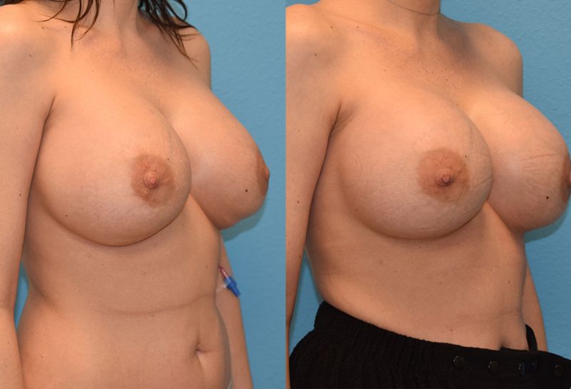Breast implant exchange by Dr. Maningas at Maningas Cosmetic Surgery in Joplin, MO