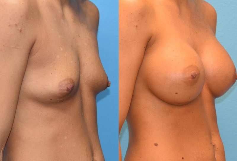 Breast augmentation results by Dr. Maningas at Maningas Cosmetic Surgery in Missouri and Arkansas