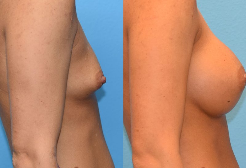 Breast augmentation results by Dr. Maningas at Maningas Cosmetic Surgery in Missouri and Arkansas