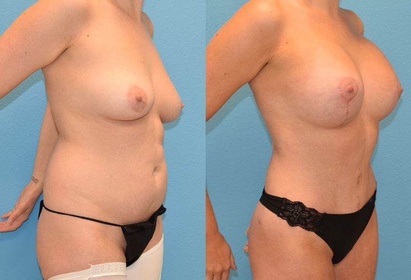 Mommy Makeover results by Dr. Maningas at Maningas Cosmetic Surgery in Joplin, MO