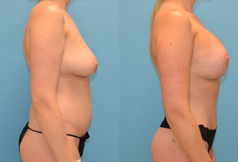Mommy Makeover results by Dr. Maningas at Maningas Cosmetic Surgery in Joplin, MO
