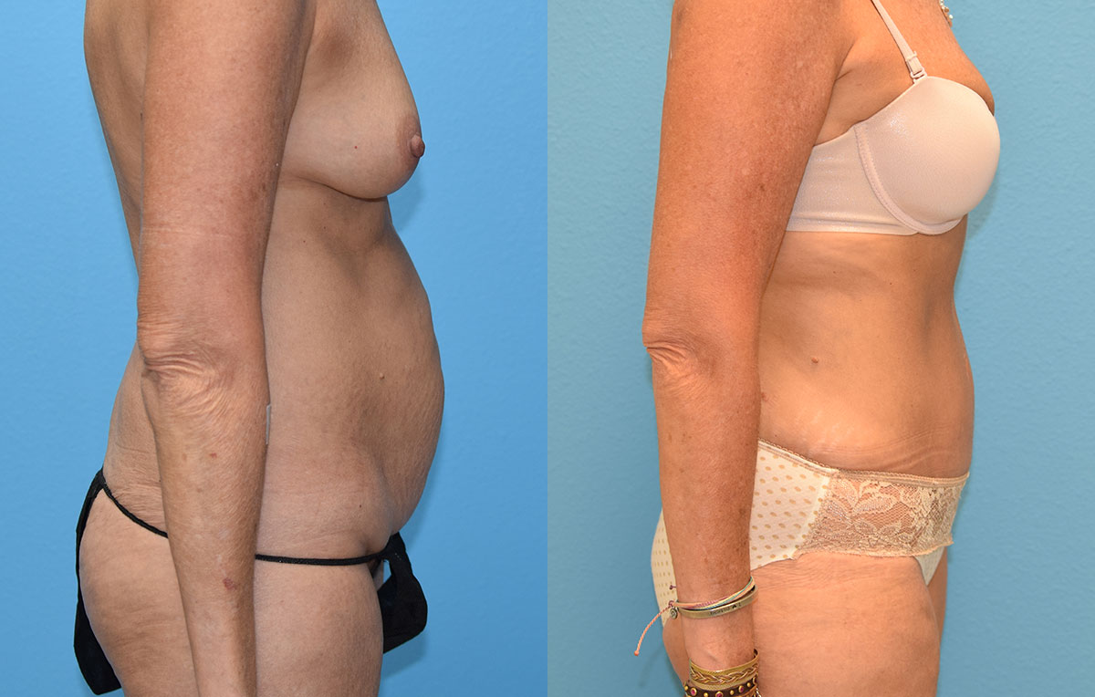 Tummy Tuck results by Dr. Maningas at Maningas Cosmetic Surgery in Missouri and Arkansas