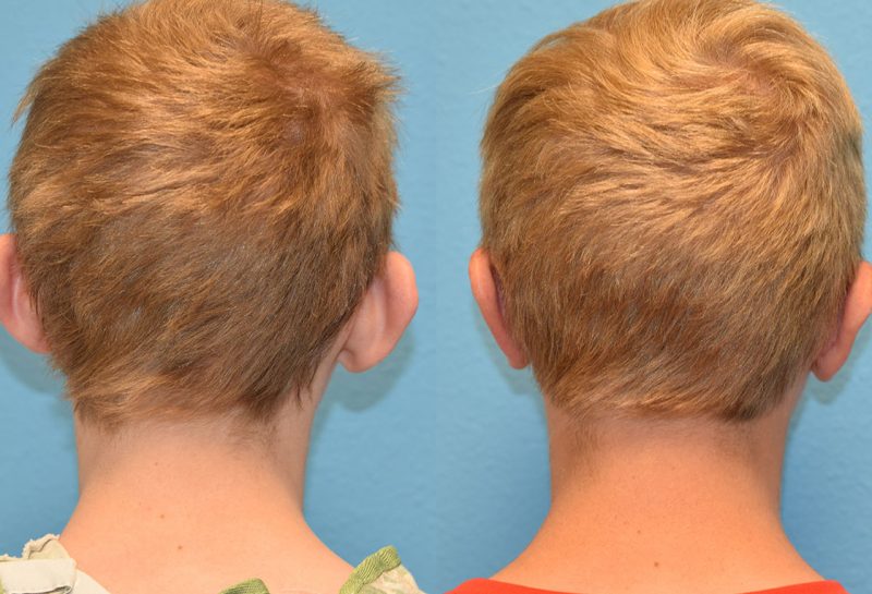 Otoplasty, or ear surgery, results by Dr. Maningas at Maningas Cosmetic Surgery in Joplin, MO