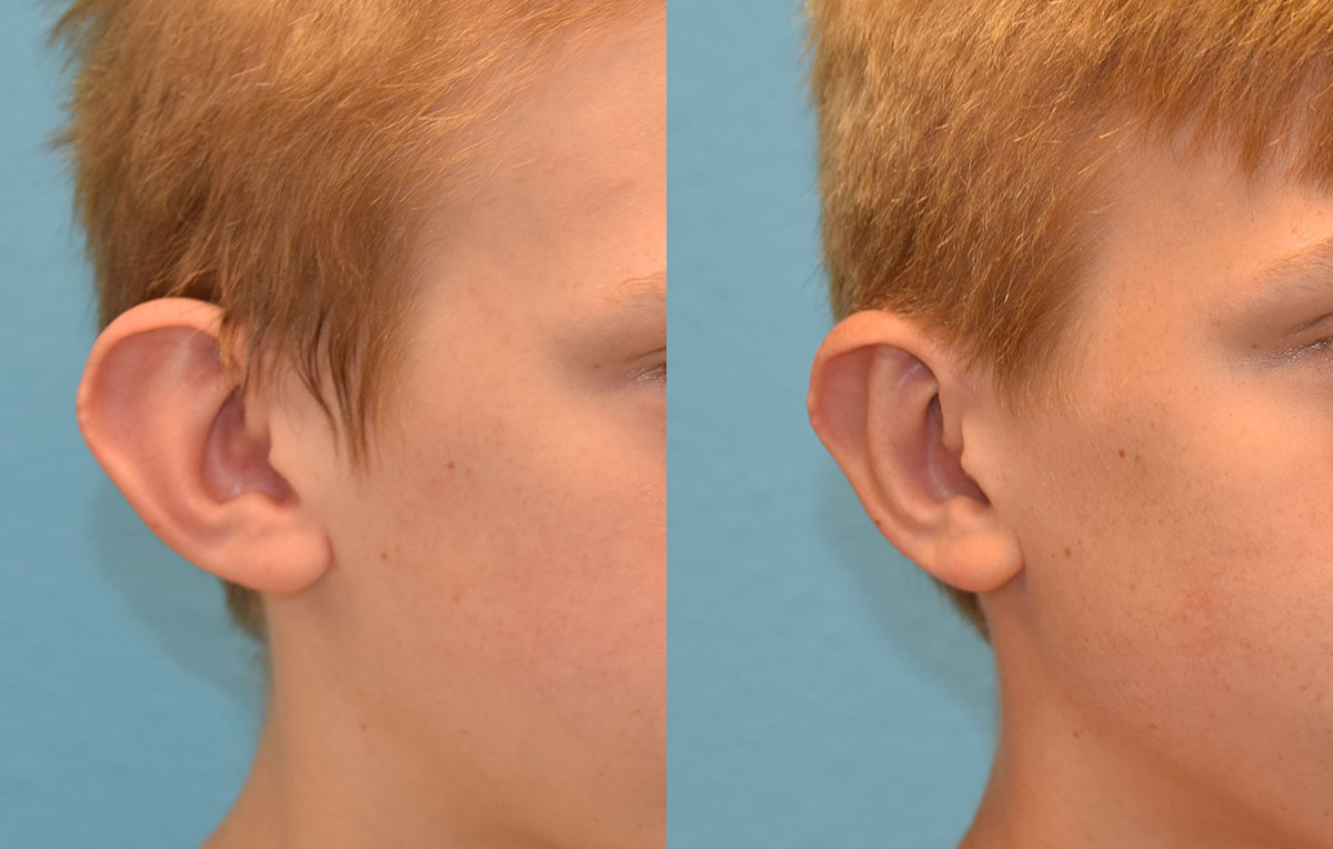Otoplasty, or ear surgery, results by Dr. Maningas at Maningas Cosmetic Surgery in Joplin, MO