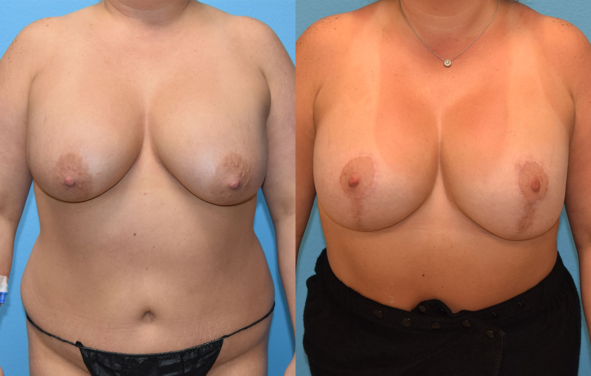 Breast lift with implants surgery by Dr. Maningas at Maningas Cosmetic Surgery in Joplin, MO
