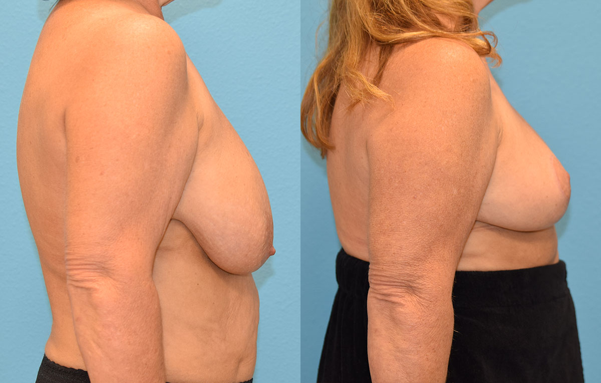 breast reduction results by Dr. Maningas as Maningas Cosmetic Surgery