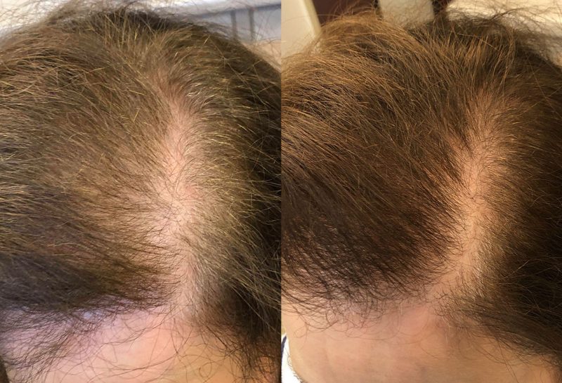 PRP injections for hair loss at Maningas Cosmetic Surgery in Joplin, MO