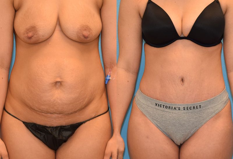 Tummy Tuck results by Dr. Maningas at Maningas Cosmetic Surgery in Missouri and Arkansas