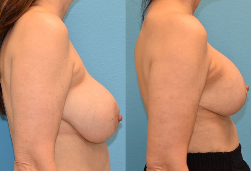 Breast Lift with Implants results by Dr. Maningas as Maningas Cosmetic Surgery
