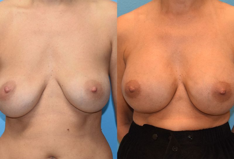 Breast implant exchange with a pocket transition from above to below the muscle. Result by Dr. Maningas, triple board certified cosmetic surgeon in Joplin, MO