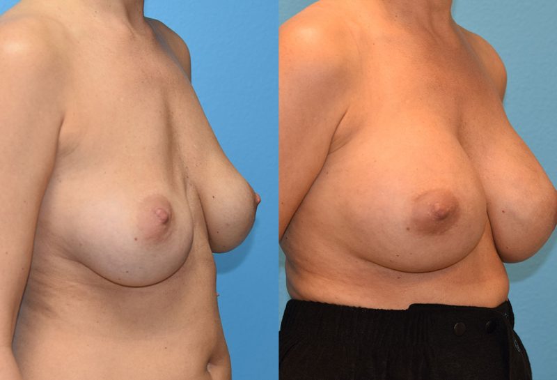 Breast implant exchange with a pocket transition from above to below the muscle. Result by Dr. Maningas, triple board certified cosmetic surgeon in Joplin, MO