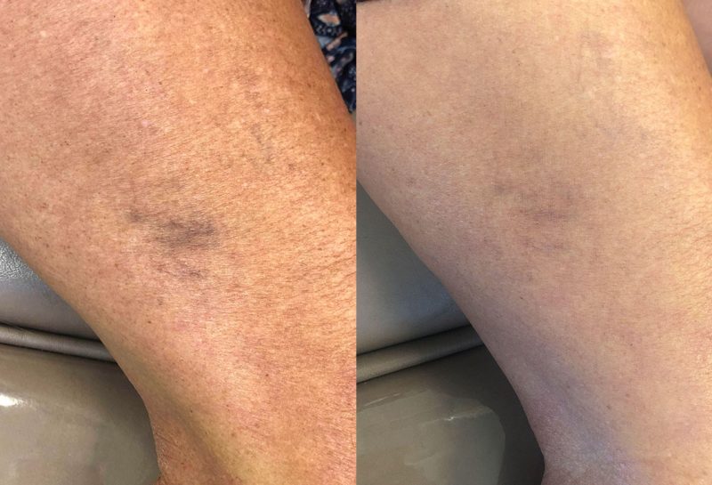 Sclerotherapy, or sider vein treatment, in Joplin, MO at Maningas Cosmetic Surgery to permanently remove small to medium sized leg spider veins