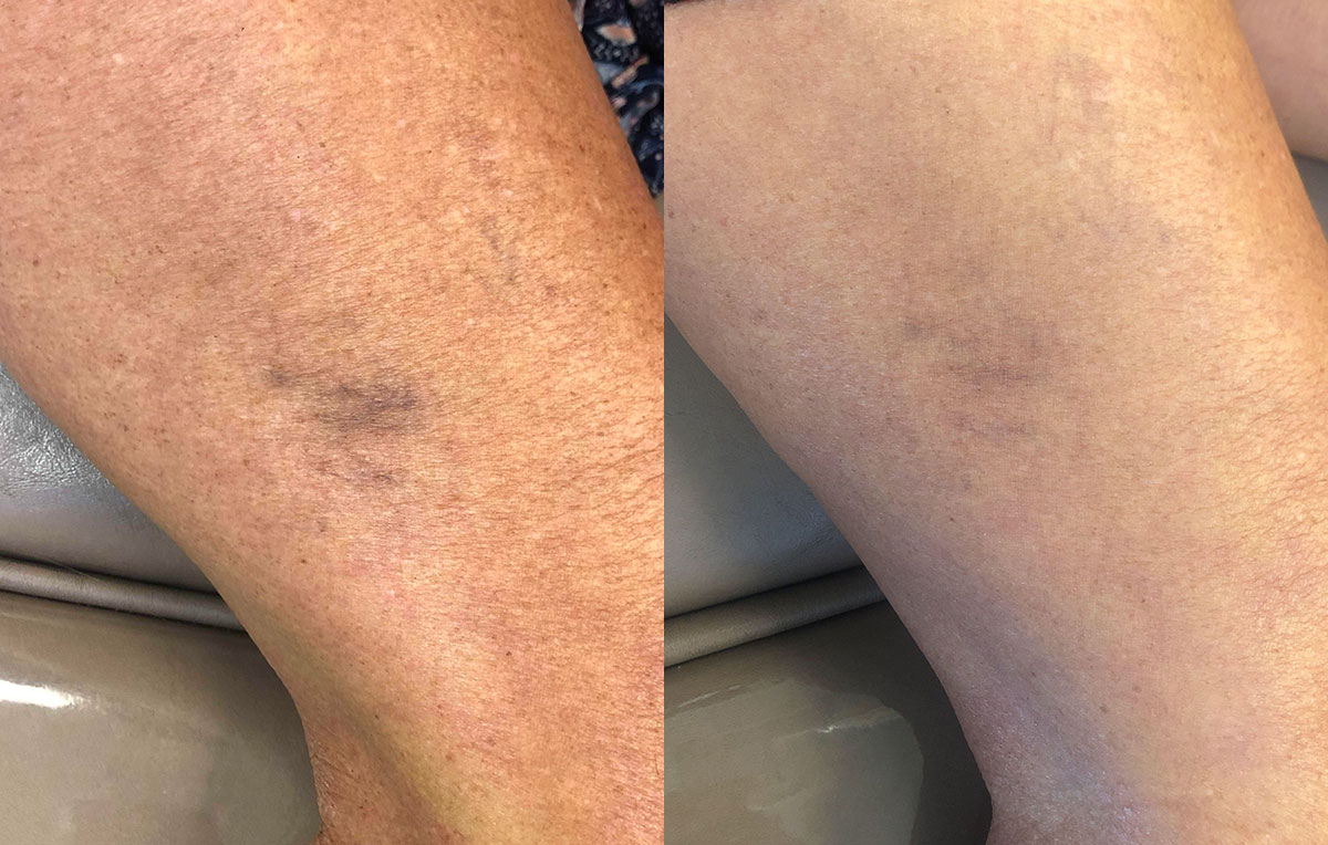 Sclerotherapy, or sider vein treatment, in Joplin, MO at Maningas Cosmetic Surgery to permanently remove small to medium sized leg spider veins