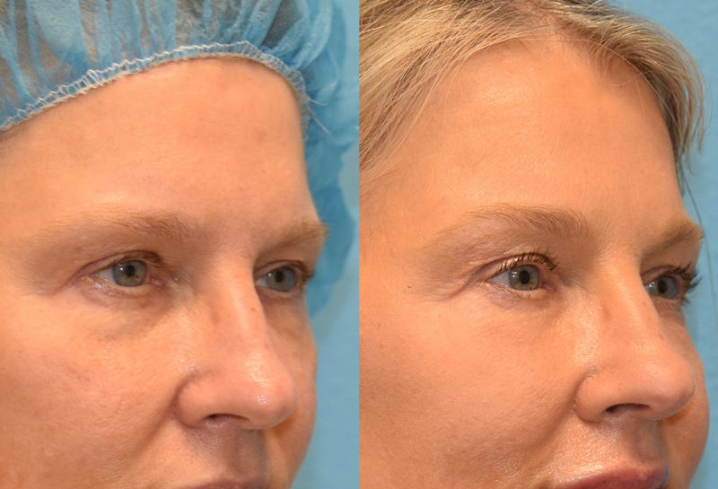 Non-surgical lower blepharoplasty with accutit. Minimally invasive procedure by Dr. Maningas in Joplin, MO