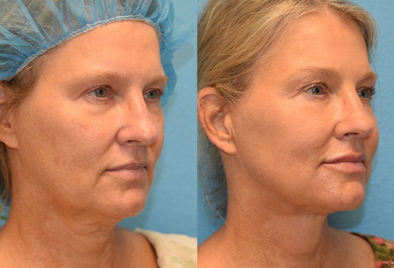 Non-surgical lower blepharoplasty and mini facelift with accutite and Facetite. Minimally invasive procedure by Dr. Maningas in Joplin, MO