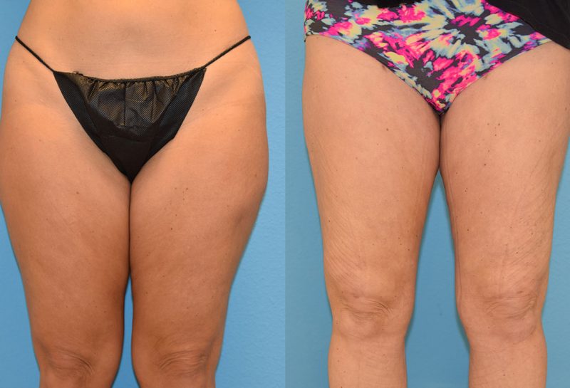 Bodytite, skin tightening and fat reduction, to the thighs by Dr. Maningas in Joplin, MO