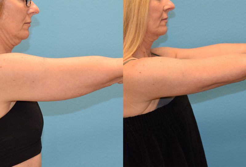 Bodytite, skin tightening and fat reduction, to the arms by Dr. Maningas in Joplin, MO