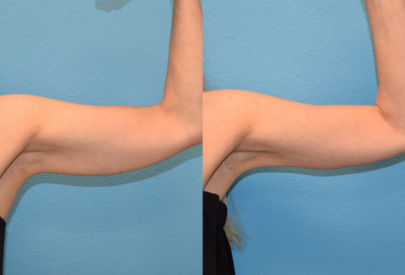 Bodytite, skin tightening and fat reduction, to the arms by Dr. Maningas in Joplin, MO