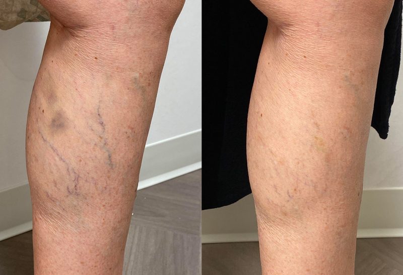 Sclerotherapy for spider veins at Maningas Cosmetic Surgery in Joplin, MO, Northwest Arkansas, Southeast Kansas, Northeast Oklahoma.