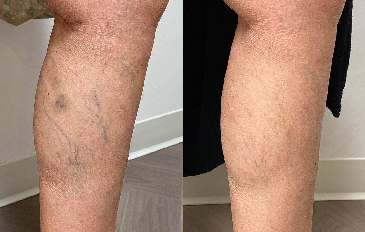 Sclerotherapy for spider veins at Maningas Cosmetic Surgery in Joplin, MO, Northwest Arkansas, Southeast Kansas, Northeast Oklahoma.