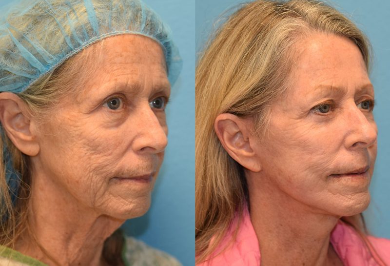 Facelift, Eyelid Surgery and CO2 laser results at Maningas Cosmetic Surgery in Joplin, MO and Northwest Arkansas