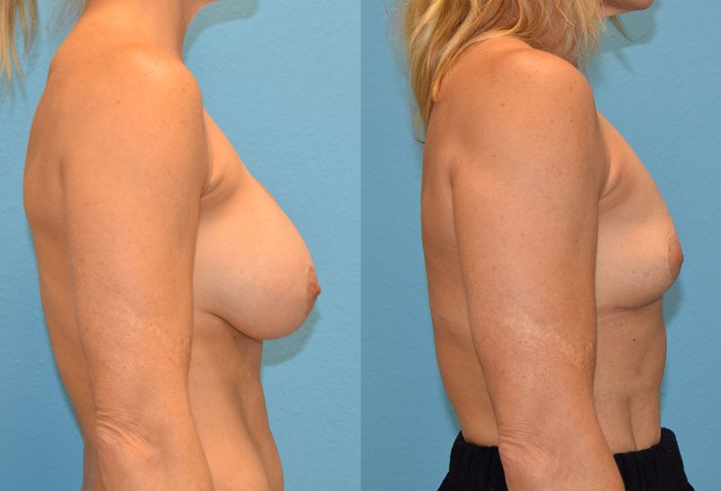 Implant Removal with a Breast Lift by Dr. Maningas at Maningas Cosmetic Surgery in Joplin, MO