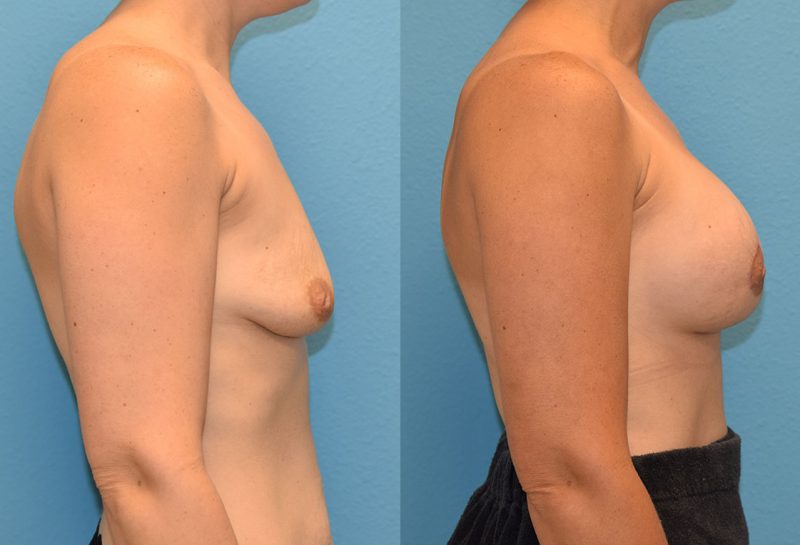 Breast Lift with Implants results by Dr. Maningas as Maningas Cosmetic Surgery
