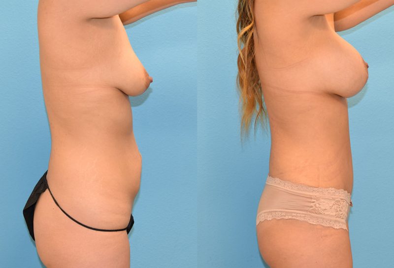 Mommy Makeover, tummy tuck and a breast augmentation with a lift, results by Dr. Maningas at Maningas Cosmetic Surgery in Joplin, MO