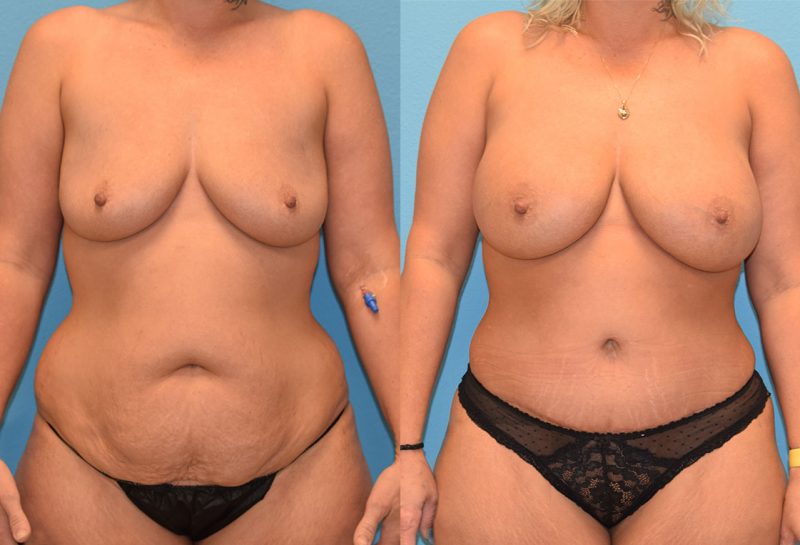 Mommy Makeover, tummy tuck and a breast augmentation with a lift, results by Dr. Maningas at Maningas Cosmetic Surgery in Joplin, MO