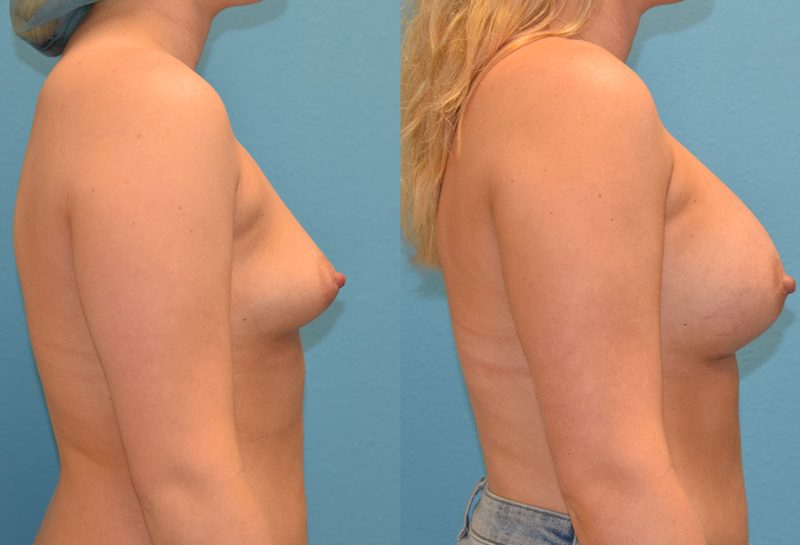 4 months post-op results of a breast augmentation with 450cc implants by Dr. Talon Maningas at Maningas Cosmetic Surgery in Missouri