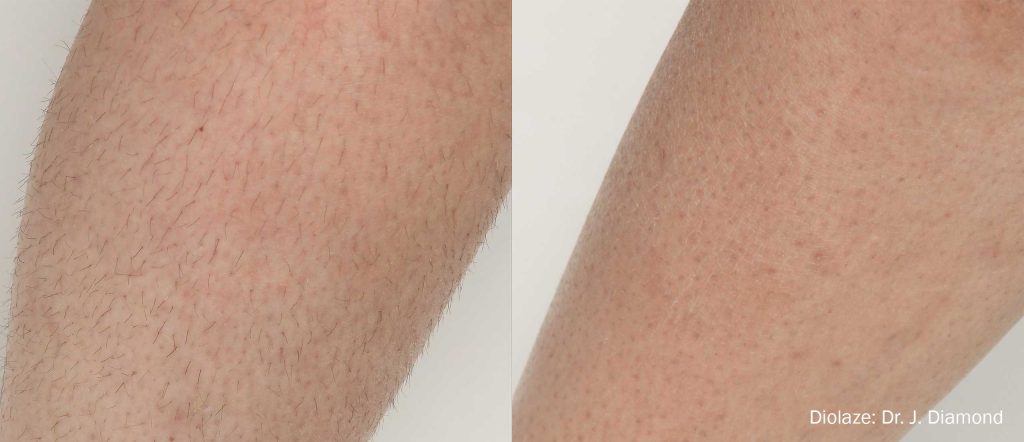 Diolaze laser hair reduction before and after results