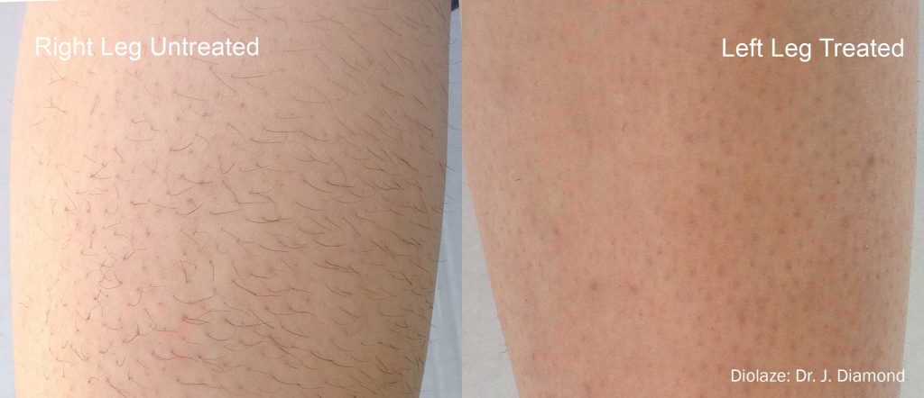 Diolaze laser hair reduction before and after results on leg hair