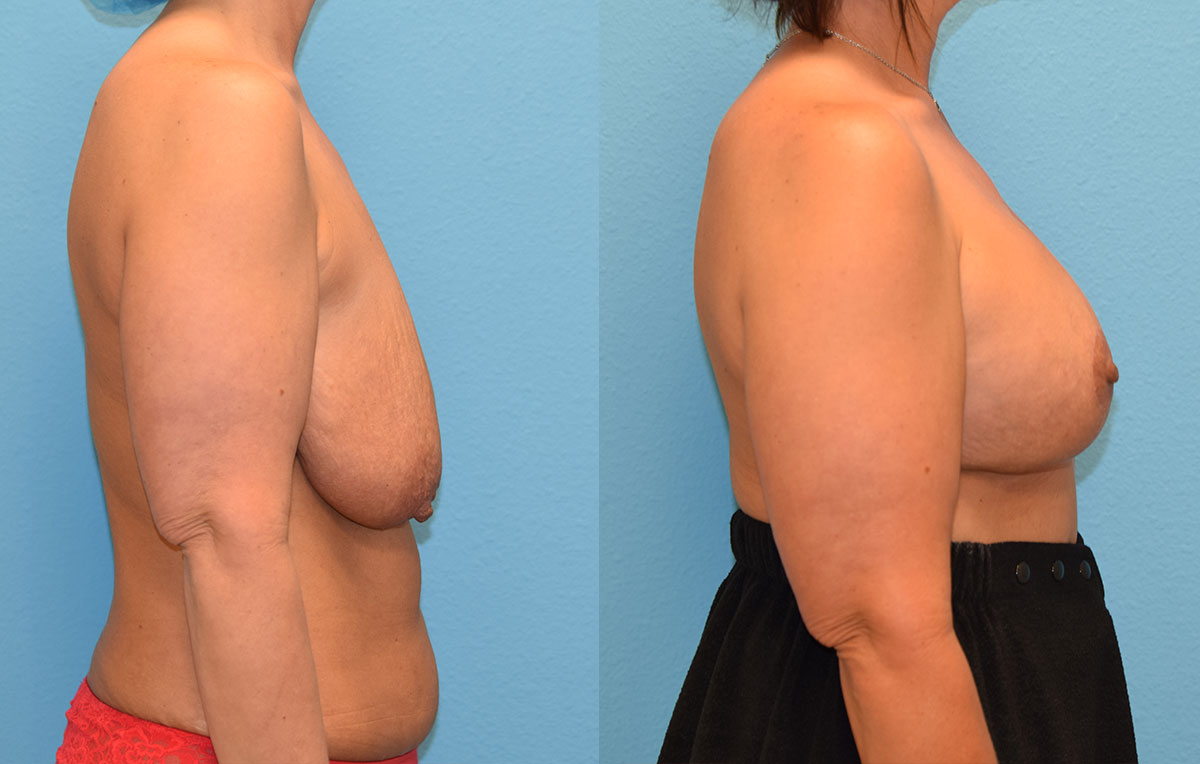 7 months post-op results of a breast lift with 375cc implants by Dr. Talon Maningas at Maningas Cosmetic Surgery in Missouri