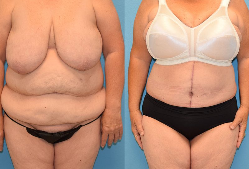 Fleur de lis Tummy tuck results by Dr. Maningas at Maningas Cosmetic Surgery in Joplin, MO