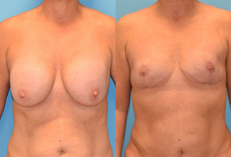 6 months post-op results of an implant implant removal and en bloc capsulectomy with a breast reduction lift by Dr. Maningas at Maningas Cosmetic Surgery in Missouri