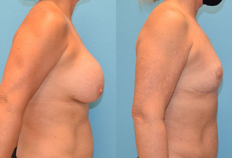 6 months post-op results of an implant implant removal and en bloc capsulectomy with a breast reduction lift by Dr. Maningas at Maningas Cosmetic Surgery in Missouri