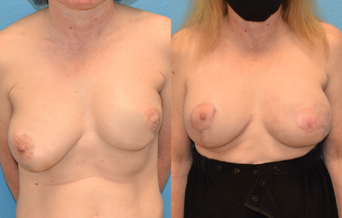 Breast revision surgery including a breast implant exchangeto the left and new implant to the right with fat transfer and a free nipple graft by Dr. Maningas in Joplin, MO