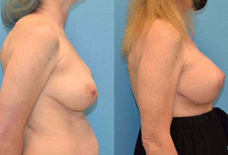 Breast revision surgery including a breast implant exchangeto the left and new implant to the right with fat transfer and a free nipple graft by Dr. Maningas in Joplin, MO