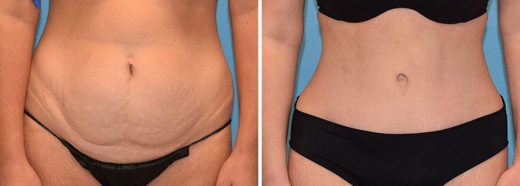Maningas Cosmetic Surgery Tummy Tuck Before and After Results