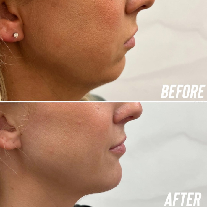 Real patient of Joplin medical spa shown before and after fillers to the chin and jawline to improve facial balance