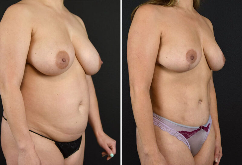 Mommy makeover with breast reduction before and after results
