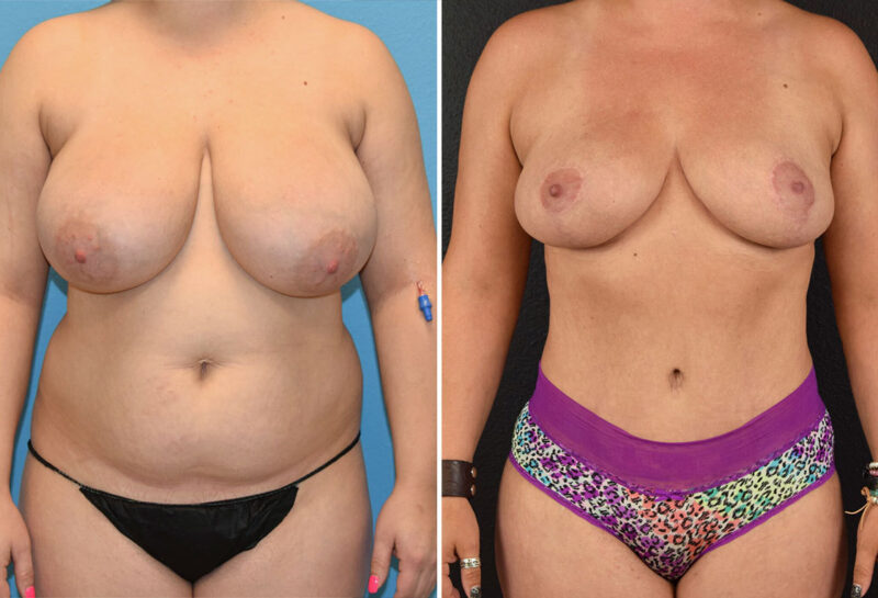 Mommy makeover with breast reduction before and after results