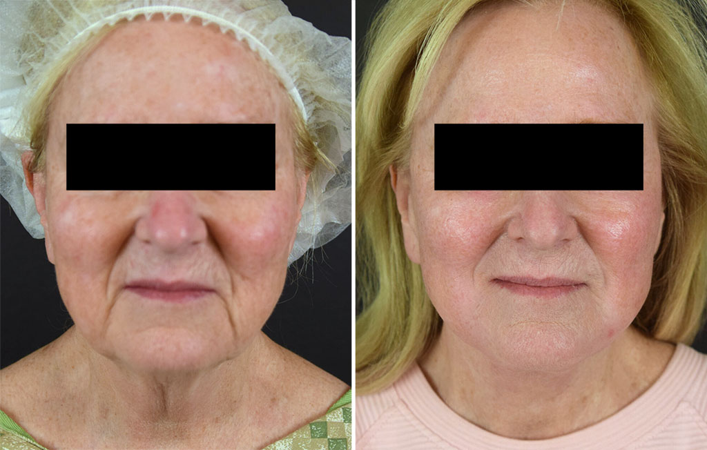 facelift-26429-7985a-maningas