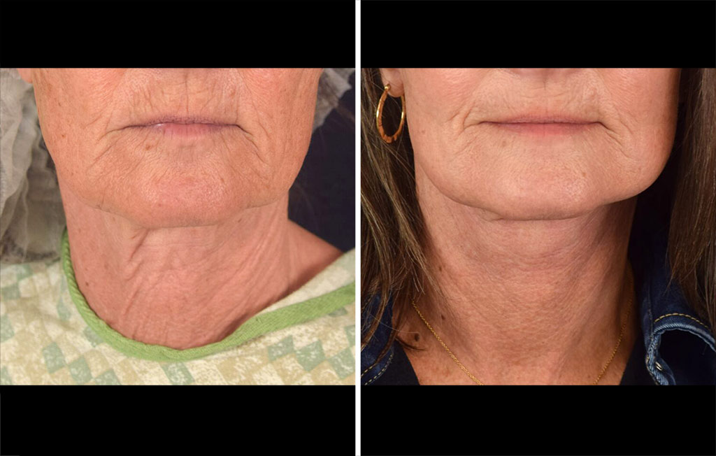 facelift-lasers-27319-15594a-maningas