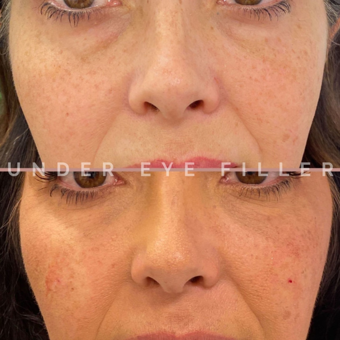 Before and after under eye filler