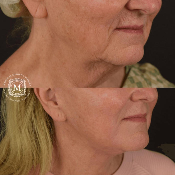 Woman shown before and after lower face and neck lift with C02 laser treatment at Maningas Cosmetic Surgery