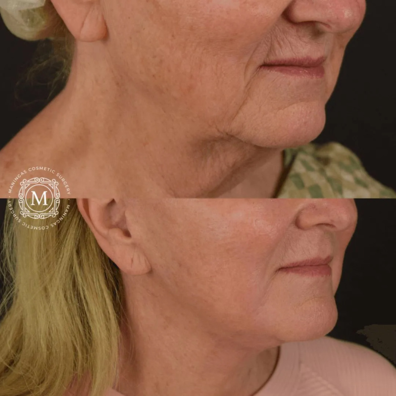 Female patient of Dr. Talon Maningas shown before and after a lower face and neck lift with CO2 laser skin resurfacing